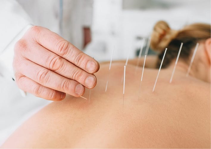 dry-needling dry-needling