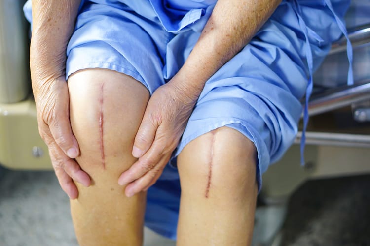 top-5-mistakes-after-knee-replacement top-5-mistakes-after-knee-replacement