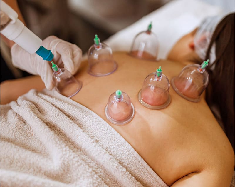 Person receiving Dry Cupping Therapy with suction cups on back, promoting blood flow and muscle relaxation at FFC Wellness.